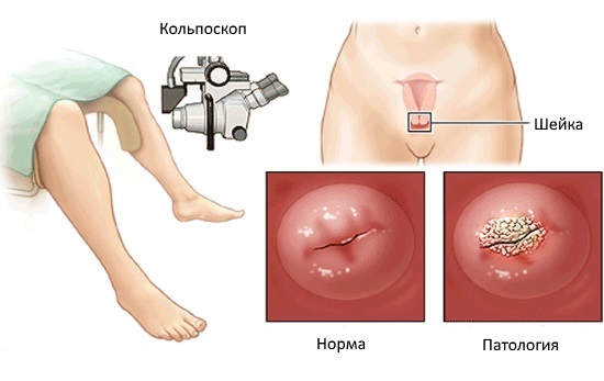 Больно ли делать кольпоскопию или нет: отзывы, техника проведения