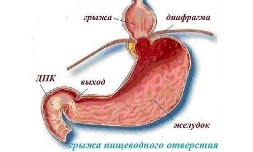 Диафрагмальная грыжа у детей: причины, симптомы, диагностика, лечение