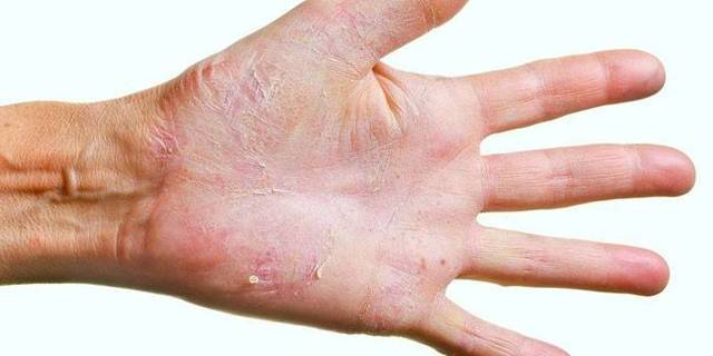 Грибок ногтей на руках (онихомикоз): симптомы, лечение. Фото