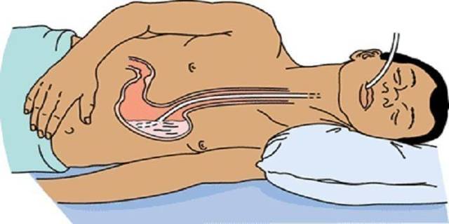 Промывание желудка - алгоритм и техника проведения процедуры