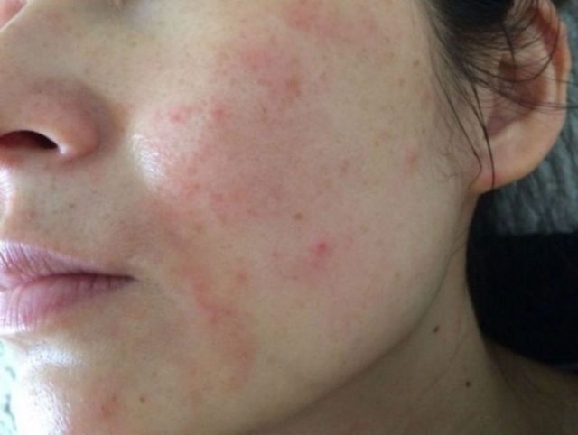 Аллергия на лице: причины, симптомы, фото, лечение