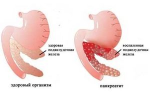 Панкреатит у детей: причины, первые признаки и лечение