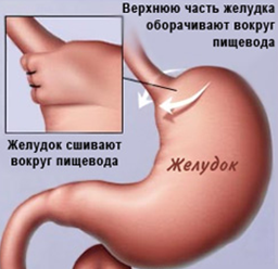 Эндоскопические признаки кардии. Пищевод желудок Кардия. Недостаточность кардии желудка что это такое.