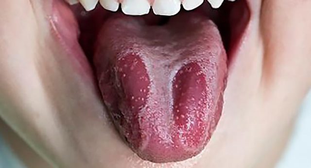 Кандидоз полости рта у взрослых: причины и лечение, симптомы молочницы слизистой рта