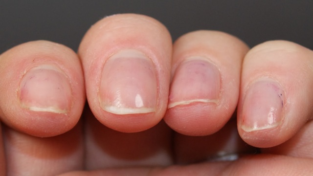 Слоятся ногти на руках – причины, что делать, когда сильно слоятся ногти на руках, лечение