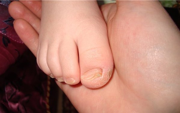 Чем лечить грибок на ногах у ребенка