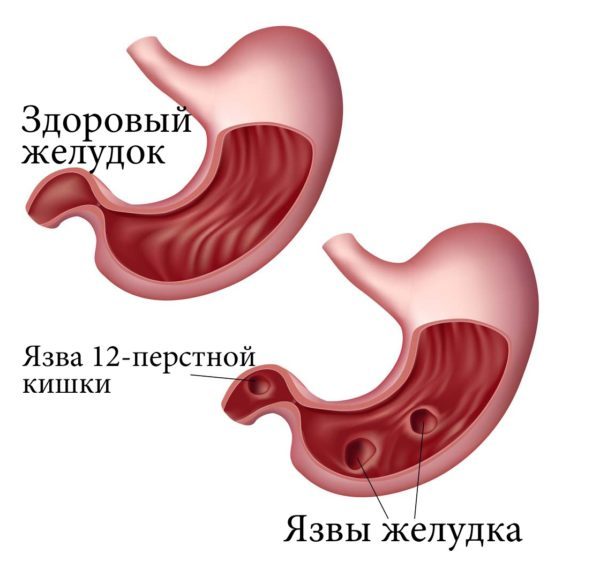Воспаление брюшной полости. Симптомы и лечение