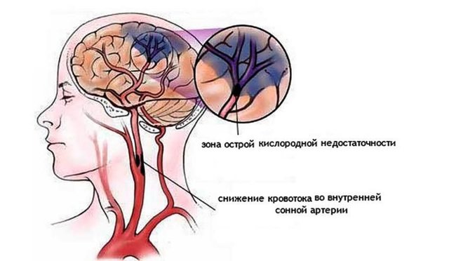 Хроническая ишемия головного мозга