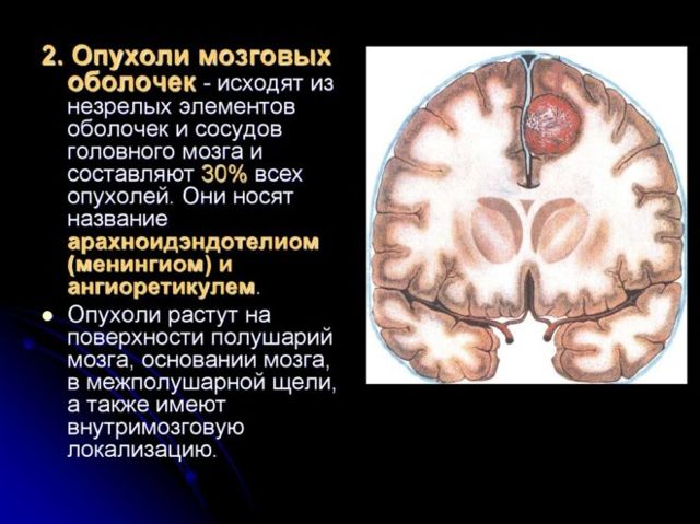 Чем вызвана менингиома головного мозга - причины, симптомы, лечение