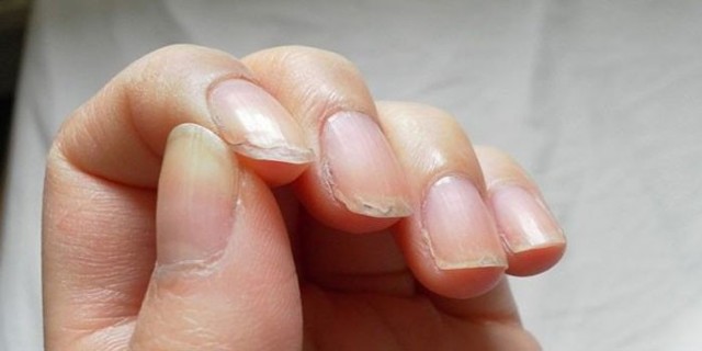 Как избавиться от слоения ногтей - слоятся ногти