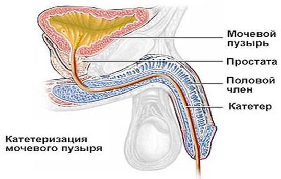 Катетеризация мочевого пузыря у мужчин и женщин: показания противопоказания к процедуре и виды катетеров