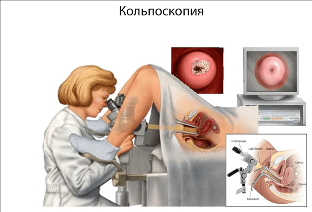 Больно ли делать кольпоскопию или нет: отзывы, техника проведения