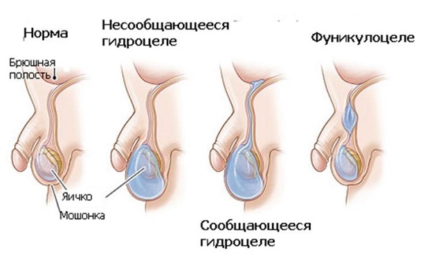 Водянка у мужчин (гидроцеле) – симптомы и лечение