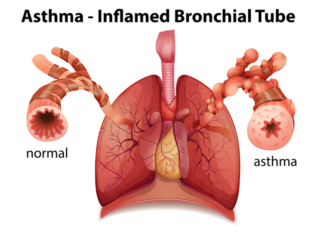 Бронхиальная астма у детей: симптомы и лечение