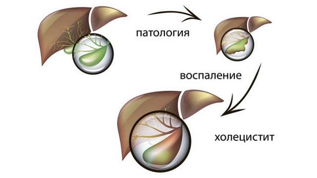 Приступ холецистита: симптомы, причины и лечение