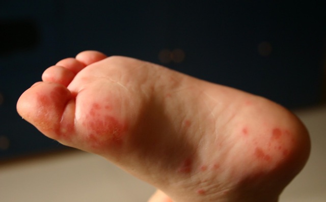 Волдыри на пальцах ног: причины и методы лечения