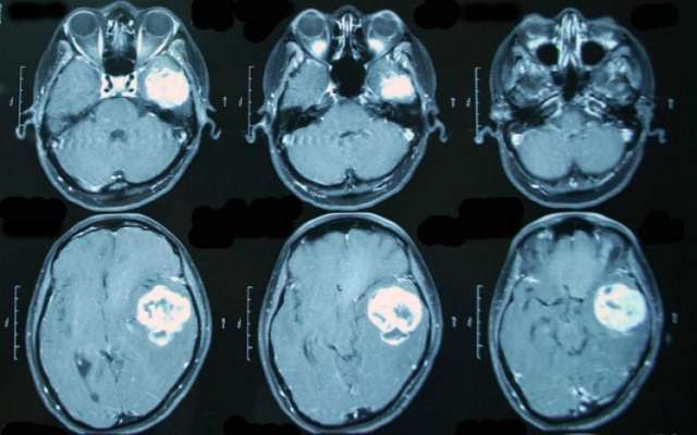 Глиза в головном мозге в белых веществах (единичные) на МРТ: что это такое?