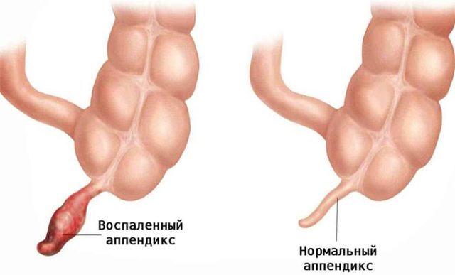 Может ли быть понос при аппендиците и как его лечить