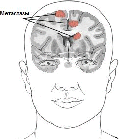 Метастазы в головном мозге: продолжительность жизни, симптомы, лучевая терапия при метастазах мозга