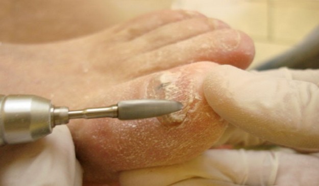 Кандидоз ногтей — симптомы и лечение