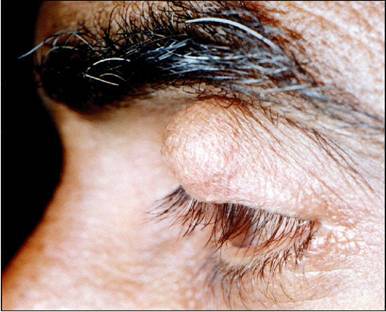 Цистицеркоз у человека: мозга, глаз – симптомы, лечение