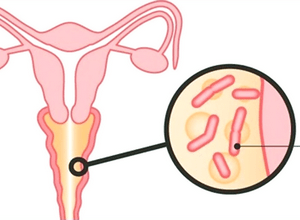 Кандидоз половых органов – лечение у женщин и мужчин