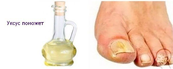 Яблочный уксус от грибка ногтей на ногах: лечение, отзывы
