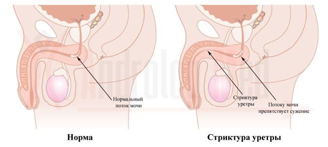 Затрудненное мочеиспускание у мужчин - причины и лечение