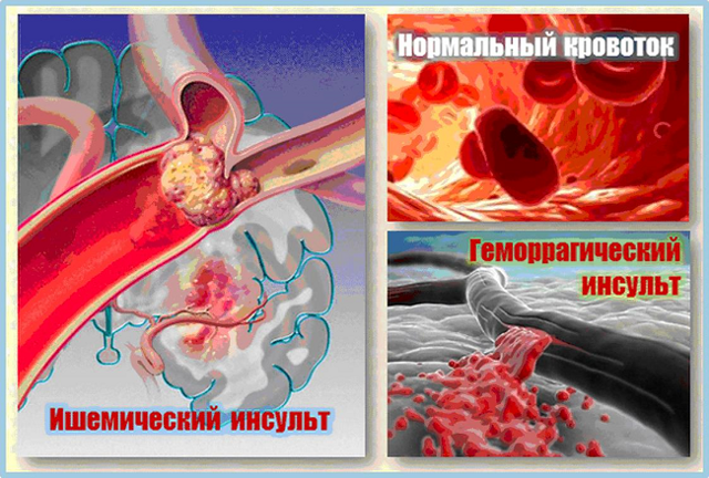 Правильное питание, как мера профилактики инсульта