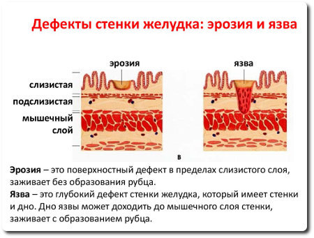 Эрозия желудка - симптомы и лечение заболевания