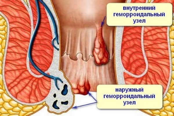 Внутренний и наружный геморрой: чем отличается лечение