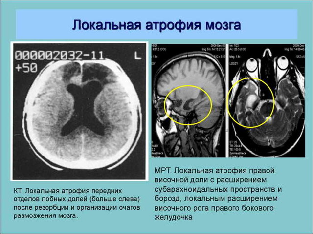 Атрофия головного мозга: виды, причины, симптомы, лечение