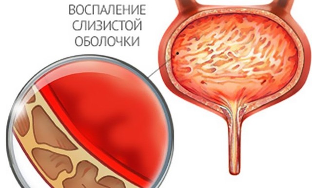 Причины наличия слизи в моче у мужчин