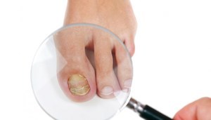Лечение грибка ногтей Флуконазол: состав, свойства, отзывы, аналоги