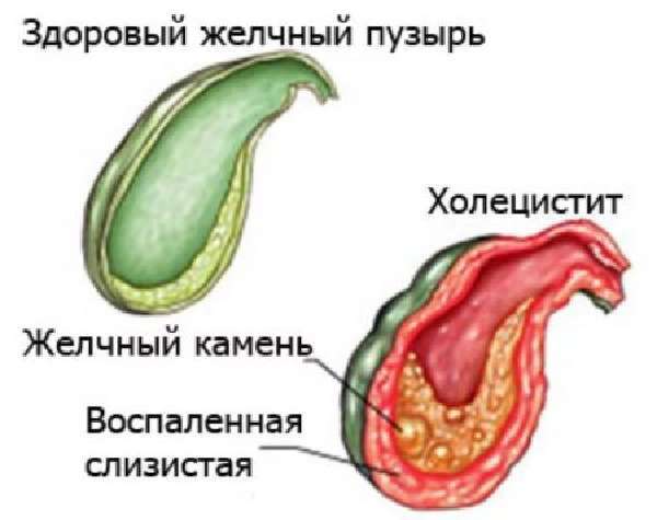 Боль в прямой кишке болезни симптомы диагностика лечение профилактика рекомендации