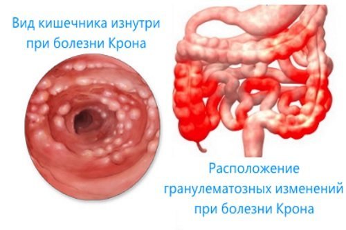 Тонкий кишечник человека, основные заболевания и симптомы