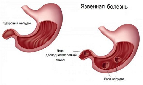 Болит желудок после еды: причины и лечение