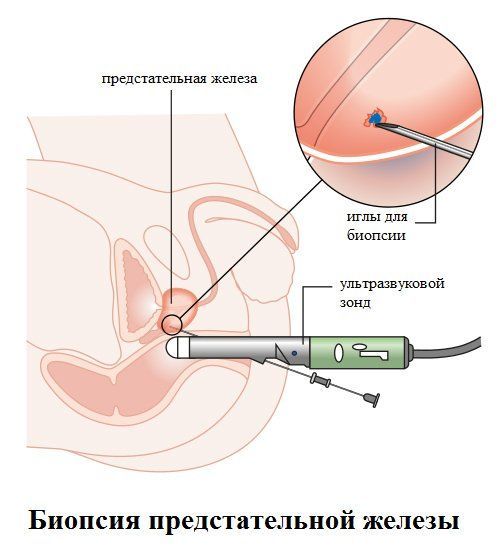 Затрудненное мочеиспускание у мужчин - причины и лечение