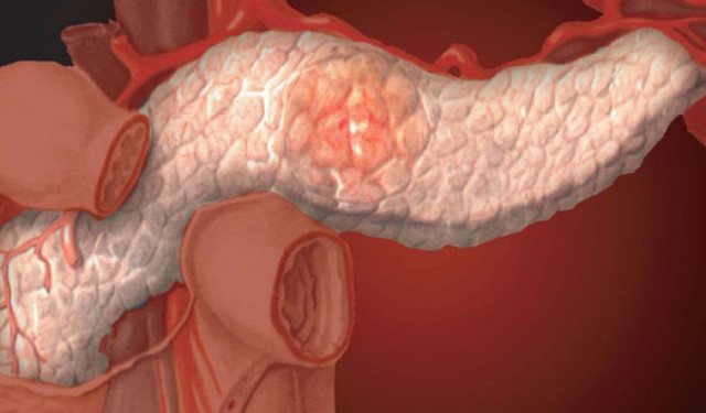 Поджелудочная железа: симптомы панкреатита и других заболеваний