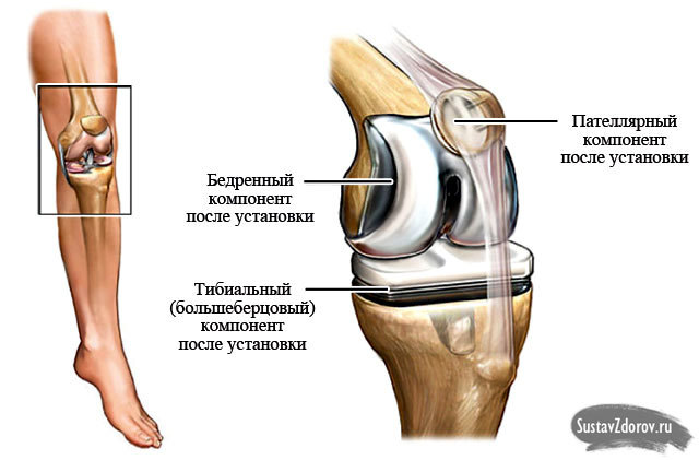 Обезболивающие после операции на коленном суставе