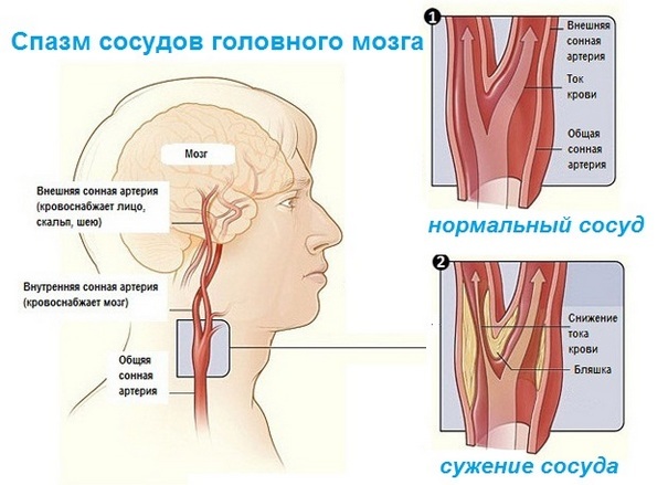 Спазм сосудов головного мозга: симптомы и лечение (препараты, таблетки)