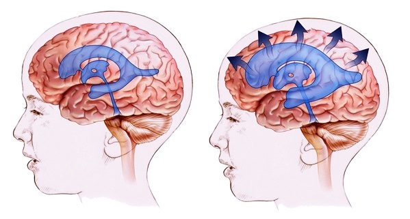 Как измерить внутричерепное давление - диагностика в клинике и домашних условиях у взрослого или ребенка