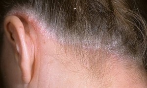 Что такое микоз волосистой части головы и как его лечить?