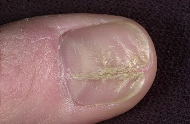 Кандидоз ногтей — симптомы и лечение