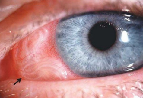 Цистицеркоз у человека: мозга, глаз – симптомы, лечение