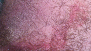 Лечение пахового грибка - симптомы, эффективные методы и средства против поражения кожи