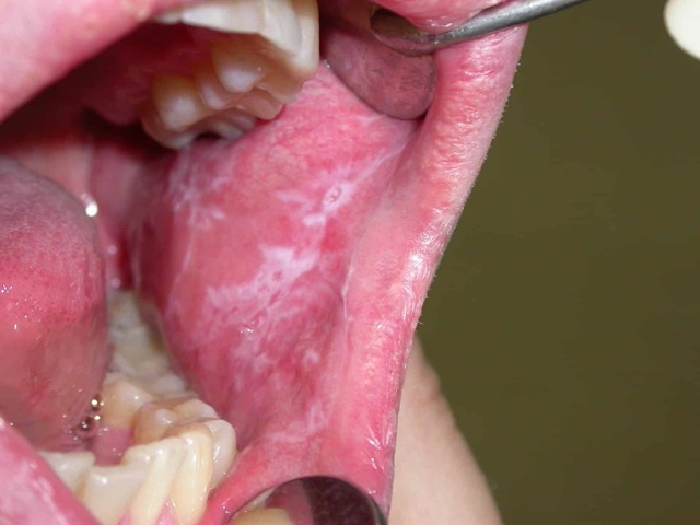 Рак полости рта - симптомы начальной стадии, диагностика, фото