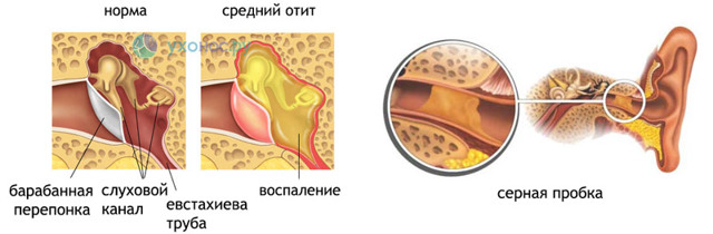 Ощущение воды в ухе: причины и лечение