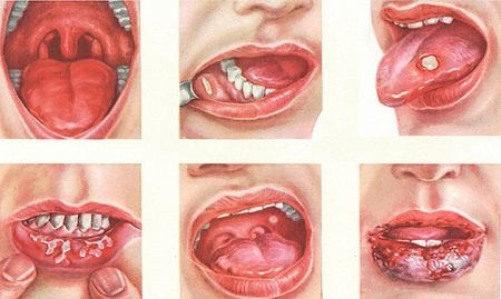 Белый налет во рту, на губах у грудничка, причины точек и пятнышек