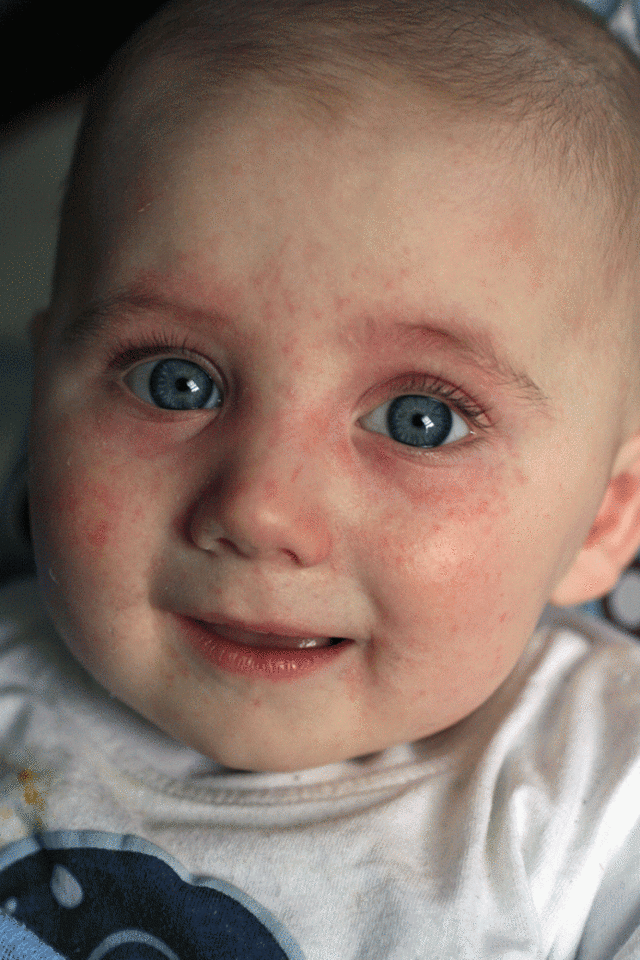 Как выглядит аллергия у грудничка на лице фото